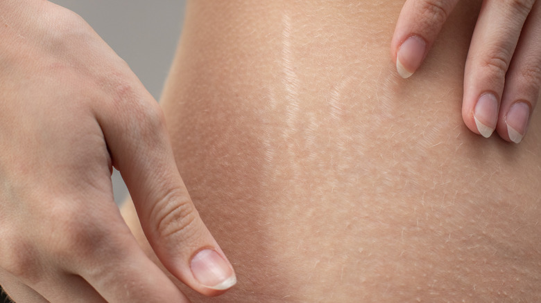woman hands stretch marks on hip belly