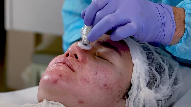 woman getting procell microchanneling treatment 